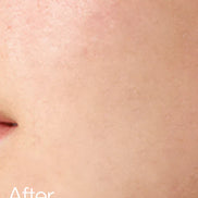 Anua BHA 2% Toner 150ml tónico exfoliante poros acné