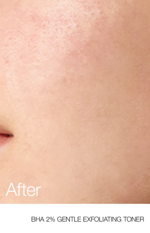 Anua BHA 2% Toner 150ml tónico exfoliante poros acné