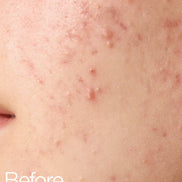 Anua BHA 2% Toner 150ml tónico exfoliante poros acné