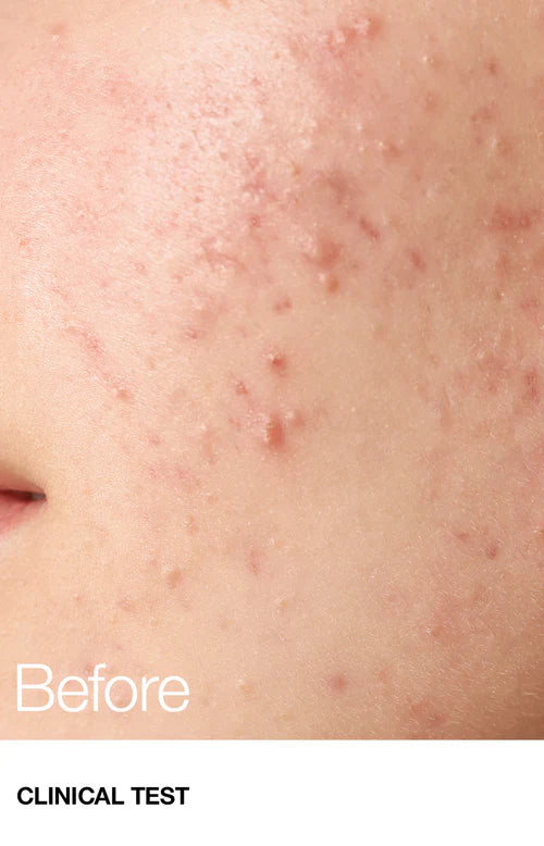 Anua BHA 2% Toner 150ml tónico exfoliante poros acné