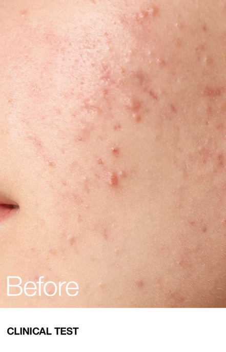 Anua BHA 2% Toner 150ml tónico exfoliante poros acné